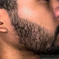 حراج مشاوره رایگان جهت رویش ریش