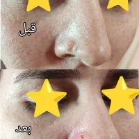 لیزر موهای زائدسوپرانو تیتانیوم برداشت انواع خال