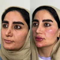 فیلر،لب های خوش فرم ،فیس متعادل و طبیعی