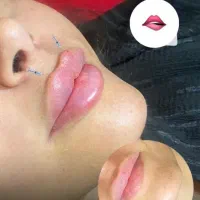 ژل وبوتاکس|خدمات آرایشگری و زیبایی|ایذه, |دیوار