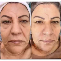 اندولیفت/ جوانسازی /تخلیه چربی صورت / رفع سلولیت|خدمات آرایشگری و زیبایی|تهران, صادقیه|دیوار
