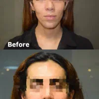 متقاضی مدل فیلر بوتاکس لیفت نخ|خدمات آرایشگری و زیبایی|تهران, دروس|دیوار