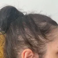 مشکل ریزش مو و خالی شدن کف سر داری