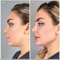 فیلر و بوتاکس پرسینگ چال لپ...|خدمات آرایشگری و زیبایی|قرچک, شهرک گلها|دیوار