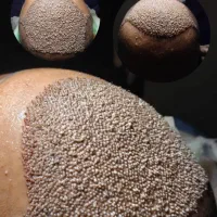 کاشت مو و ابرو