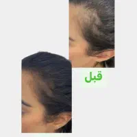 درمان ریزش مو|آرایشی، بهداشتی، درمانی|مشگین شهر, |دیوار