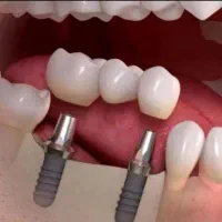 ایمپلنت دیجیتال/تهران و کرج/ویژه مراجعین از قزوین|خدمات آرایشگری و زیبایی|قزوین, |دیوار