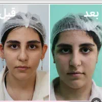 عمل گوش (اتو پلاستی)