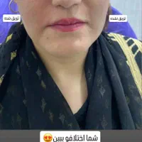 ژل، بوتاکس،آنزیم،مزوتراپی پی ار پی،فیلر بادی|خدمات آرایشگری و زیبایی|اهواز, گلستان|دیوار