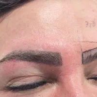 مدل کاشت ابرو رایگان زیر نظر پزشک و اساتید مجرب