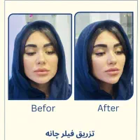 فیلر لب روسی -زاویه سازی -بوتاکس-پی ار پی -مزو|خدمات آرایشگری و زیبایی|تهران, دریا|دیوار