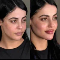 تزریق چربی صورت ،بیکینی ،سینه و دست