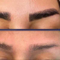 ریموو تتو صورت و بدن