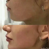 ژل لب.بوتاکس|خدمات آرایشگری و زیبایی|شیراز, شهرک فرزانگان|دیوار