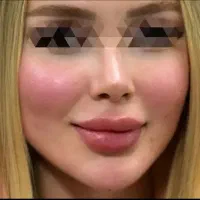 ژل لب کره‌ای کانتورینگ فول‌فیس بوتاکس چال گونه