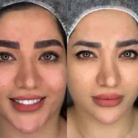رژلب و شیدینگ بدون درد و میکروی تخصصی و ریموو