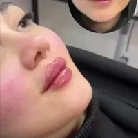 تزریق ژل لب .بوتاکس.لیفت نخ . درمان لک|خدمات آرایشگری و زیبایی|درگهان, |دیوار