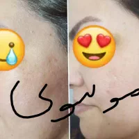 روشن کننده و رفع هرنوع مشکل پوستی بدون بازگشت|آرایشی، بهداشتی، درمانی|لردگان, |دیوار