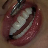 کامپوزیت دندانپزشکی تخفیف ایمپلنت اقسلط 50 درصد