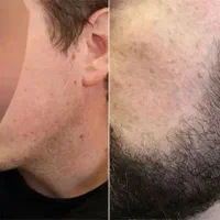 رویش و پرشتی ریش