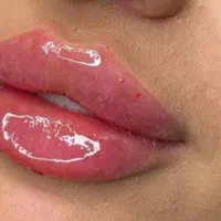 ژل فیلر آنزیم بوتاکس ناخن