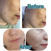 تخفیف ویژه یلدا و روز مادر فیشال تخصصی پوست