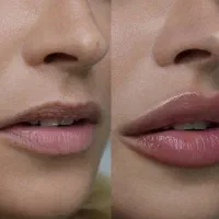 تزریق فیلر و بوتاکس توسط پزشک همراه تخفیف