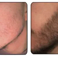 رویش ریش و سیبیل ۳۰ روزه