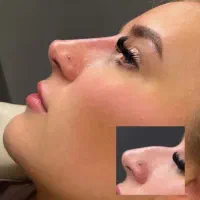 مرکز زیبایی بوتاکس و فیلر و تمامی خدمات زیبایی|خدمات آرایشگری و زیبایی|اصفهان, ملکشهر|دیوار