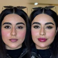 جشنواره ژل و بوتاکس با قیمت باورنکردنی/اقساط