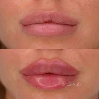 مدل تزریق‌ ژل‌ ومزوژلها