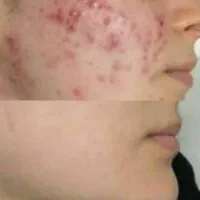 ضدلک 20ترکیبه ،به ضمانت برگشت وجه