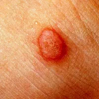 درمان زگیل، خال