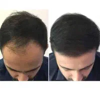 پی آر پی تخصصی /  توسط پزشک متخصص|خدمات زیبایی و سلامت|مشهد, شهید فرامرز عباسی|دیوار