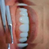 تخفیف 50 درصدی کامپوزیت و دندان پزشکی|خدمات آرایشگری و زیبایی|تهران, ایوانک|دیوار