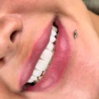 کامپوزیت دندان، لمینت، زیبایی