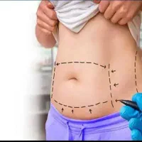 ساکشن شکم پهلو بازو ران و رفع غبغب بدون جراحی