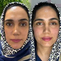 جشنواره تزریق ژل و لیفت صورت|خدمات آرایشگری و زیبایی|قم, زنبیل آباد|دیوار