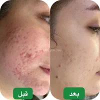 اموزش صفرتاصدفیشیال وپیرسینگ با۲۰درصدتخفیف