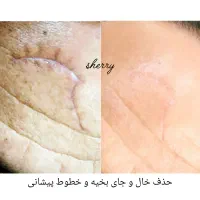 خدمات حرفه ای پاکسازی ریموو تتو و فیشال و جوانسازی|خدمات آرایشگری و زیبایی|هشتگرد, فاز ۱ مهستان|دیوار