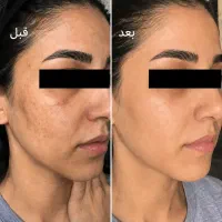 قوی ترین ضدلک تخصصی