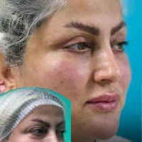 بلفارو پلاستی پلک بالا و پایین