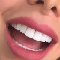 کامپوزیت دندان تخفیف ویژه روکش دندانپزشکی تهرانسر|خدمات آرایشگری و زیبایی|تهران, تهرانسر مرکزی|دیوار