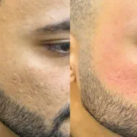 درمان جای جوش و لک و فیشال های درمانی|خدمات آرایشگری و زیبایی|اصفهان, باغ زرشک|دیوار