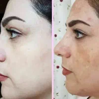 کرم سفید کننده سفیدبرفی