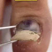 درمان ناخن تو گوشت رفته و قارچ گرفته|آرایشی، بهداشتی، درمانی|ارومیه, |دیوار