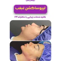 لیپو شکم،ابدو،غبغب،ماموپلاستی،فیلر بادی پروتزسینه|خدمات آرایشگری و زیبایی|شیراز, معالی‌آباد|دیوار