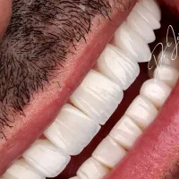 دندان مصنوعی تحویل ۵ساعته شهر محلات کامپوزیت دندان