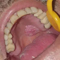 کمک و راهنمایی برای بیماری زگیل تناسلی|فعالیت داوطلبانه|شیراز, عفیف‌آباد|دیوار