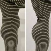 لیپو فقط ۳۰ت/ لیپوماتیک ابدو پروتز مامو لیفت سینه|خدمات آرایشگری و زیبایی|تهران, زعفرانیه|دیوار